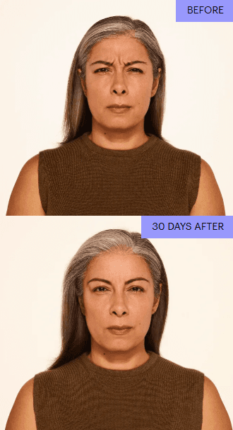 Before and after front view with softened frown lines at 30 days