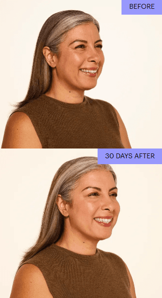 Before and after three-quarter view with a smoother, rested look at 30 days